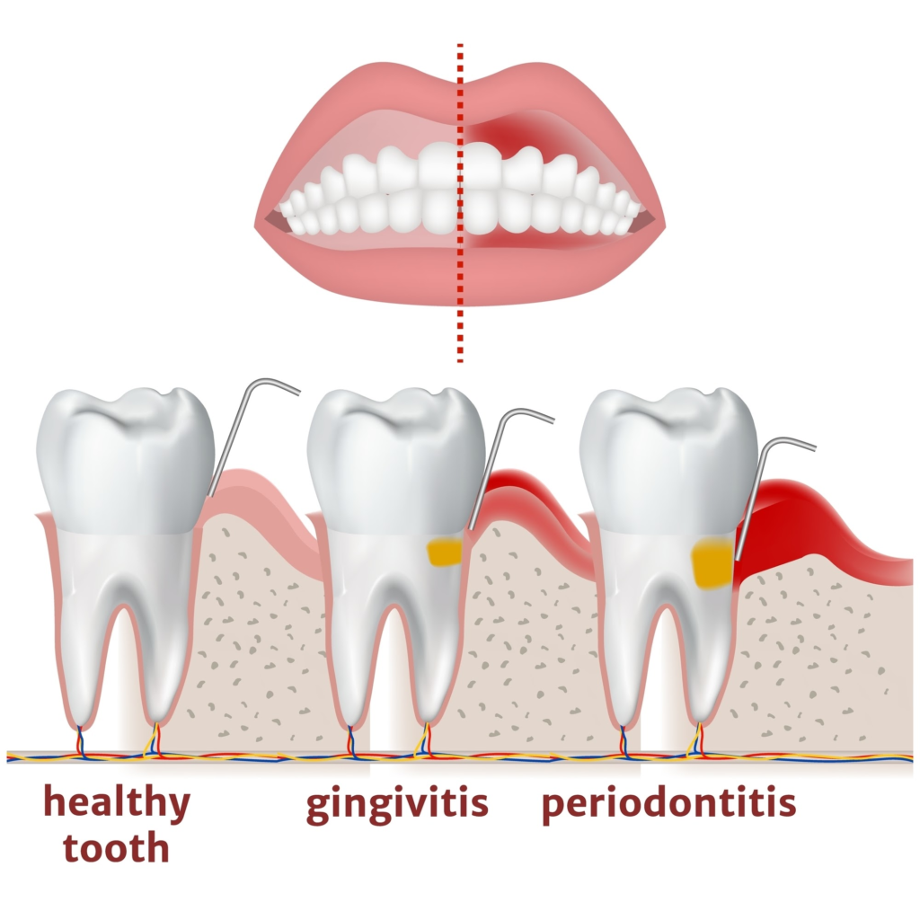 Gingivitis